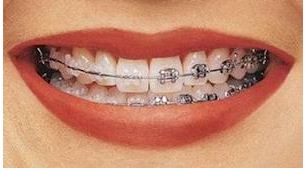 تقويم الاسنان الكريستالي في سطرين